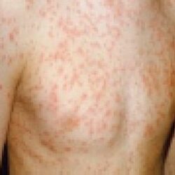 Monkeypox